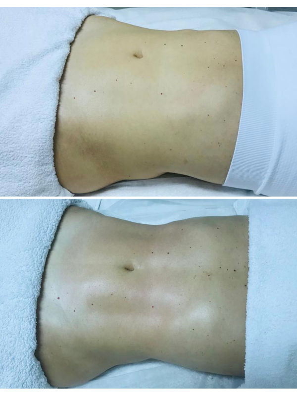 Drenagem Linfática - Equilibrato Drenagem Linfática - Equilibrato